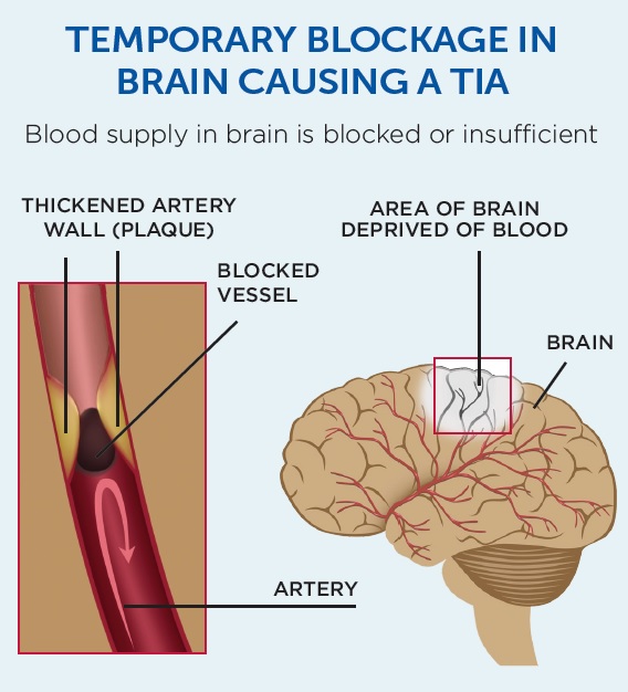 What Is A Mini Stroke